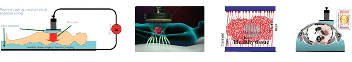 고주파 온열암치료기의 특징